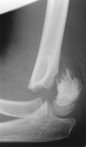 Supracondylar Fracture Pediatric Pediatrics Orthobullets supracondylar-fracture-pediatric-pediatrics-orthobullets